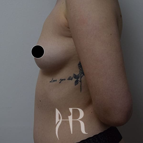 HR Plastic Surgery - Breast Enlargement patient before 8